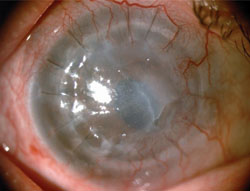 Figure 2. Preoperative and postoperative photographs after KeraKlear procedure.