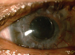 Figure 2. Preoperative and postoperative photographs after KeraKlear procedure.