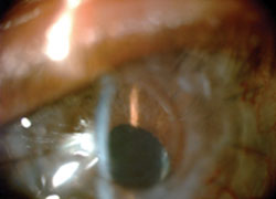 Figure 3. On day 1 after KeraKlear procedure, the iris details are visible.