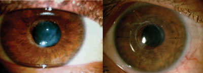 Figure 5. Preoperative and postoperative day 1 appearance of a keratoconus cornea after KeraKlear procedure.