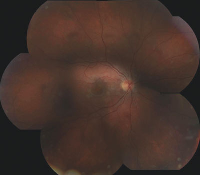 Figure 1. Fundus photograph of the right eye showing multiple white lesions. 