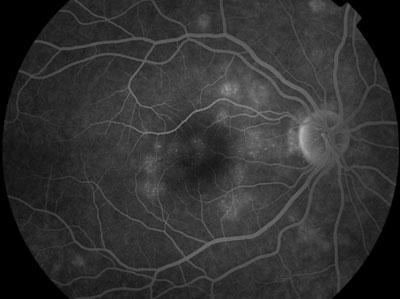 Figure 2. Fluorescein angiography (5 min., 12 sec.) of the right eye showing a wreath-like configuration of hyperfluorescent dots.