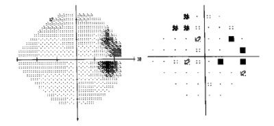 Figure 3. HVF 24-2 of the right eye. Enlarged blind spot.