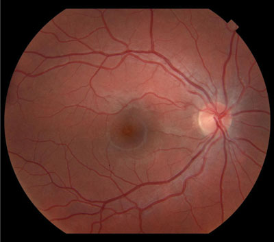 Figure 4. One-month follow-up fundus photograph of the right eye. Most of the white dots resolved. The foveal granularity persisted.