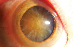 This brunescent cataract has a central zone of increased density that will require more phaco energy to emulsify.