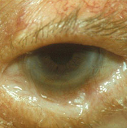 Figure 2. A cicatricial entropion with conjunctival blunting, symblepharon and trichiasis.