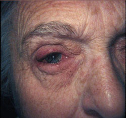 Figure 3. A cicatricial entropion due to conjunctival shortening of right lower lid.