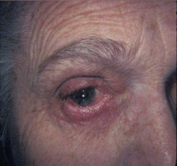 Figure 5.  Postop result following mucous membrane grafting.