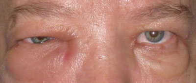 Figure 1. External photograph revealing periorbital erythema and edema in the right eye. 