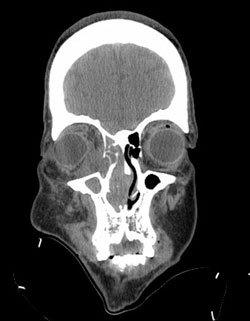 Figure 2. Coronal CT image demonstrating a large nasal mass with septal deviation, bony destruction of the medial orbital wall and medial invasion of the right orbit.