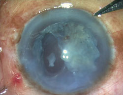 Figure 1. Posterior capsular rupture during phacoemulsification of the nucleus.