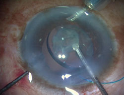 Figure 2. Foldable IOL as a scaffold prevents the nucleus drop.