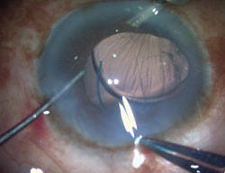 Figure 3. Foldable IOL positioned in the ciliary sulcus.