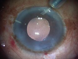 Figure 4. IOL well-centered at the end of the procedure.