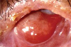 Figure 1. A successful autologous mucosal graft requires adequate suppression of the underlying ocular surface inflammation.