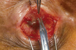 Figure 2. Careful dissection with respect to the tissue plane to excise the dense corneal pannus.