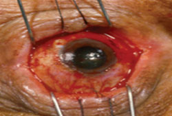 Figure 3. After excision of the ocular surface scar tissue and pannus, the underlying corneal surface and bulbar sclera are relatively unaffected.