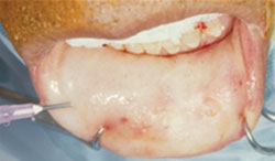 Figure 4. Infiltration of the superficial oral mucosa with 1 mL to 2 mL of 1% Xylocaine with 1:2000 epinephrine to allow easier separation from the submucosal tissues.