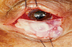 Figure 5. Fibrin tissue adhesive is used to attach the mucosal graft to the tarsus.