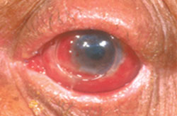 Figure 7. At 2 weeks postop, the conformer is in place. The cornea has only mild stromal opacity and is devoid of surface scar tissue and pannus.