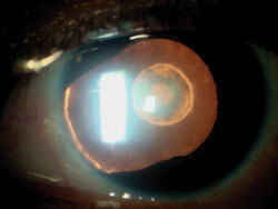 This patient has a posterior polar cataract with a congenital iris defect and absence of zonules in one quadrant.