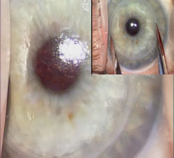 Figure 1. Main figure: Intraoperative view of a 12-year-old full-thickness PK graft that failed with corneal stromal and epithelial edema. 