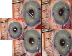 Figure 2. Top and bottom rows: Descemetorrhexis being performed within the corneal graft using the John Dexatome.