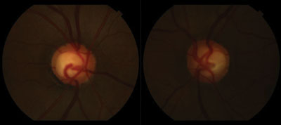 Figure 1. Optic disc photographs of the right eye and left eye, revealing cupping of both optic nerves but otherwise well-defined margins and healthy rim color.