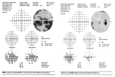 Figure 2. Humphrey visual fields (30-2). A central defect is seen in the right eye, and dense inferior and central defects are present in the left eye.