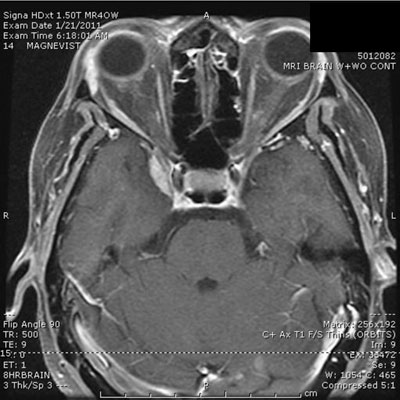 Figure 3. MRI of the orbits with gadolinium. 