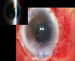 Figure 10. Normal iris anatomy is restored with resuspension of the detached iris, re-anastomosis of the bisected iris and recreation of the pupil.