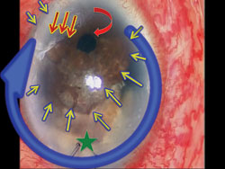 Figure 1. Patient with extensive intraoperative iris damage that occurred during phacoemulsification secondary to sudden unexpected patient movement referred for surgical management.