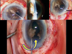 Figure 2. Intraoperative mechanical separation of the iris leaflets (insets) confirm total bisection of the iris diaphragm (yellow arrows) and the absence of a true pupil.