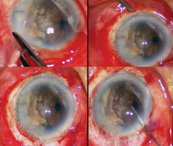 Figure 3. Conjunctival peritomy and hemostasis is achieved using a disposable cautery; viscoelastic material is injected into the anterior chamber.