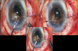 Figure 7. Needle of a 10-0 Prolene suture is passed through the clear cornea and then the first and second leaflets of the bisected iris while steadying the floppy iris leaflets using John super-micro forceps introduced through a temporal clear cornea wound; the needle finally exits the anterior chamber through the clear cornea. 