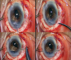 Figure 8. The sutures on either side are then pulled out of the anterior chamber using a Sinskey hook, and the suture is then tied to rejoin the bisected iris, thus creating a pupil. 