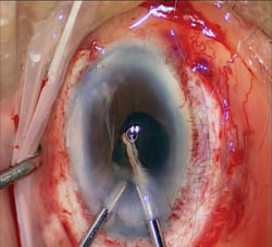 Figure 9. Bimanual anterior vitrectomy is performed to clear all vitreous and lens remnants. Notice that all the 10-0 Prolene sutures are left untied until the end of the procedure.