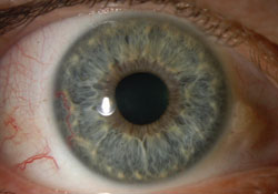 Figure 1a. Slit lamp biomicroscopy showed the iris lesion in the right eye. A very subtle irregularity in the pupil margin could be detected.