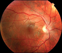 Figure 1a. Fundus photography showing temporal optic nerve pallor and maculopapillary retinal nerve fiber layer loss in the right eye.