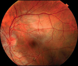 Figure 1b. Diffusely swollen optic nerve and peripapillary telangiectatic vessels in the left eye.