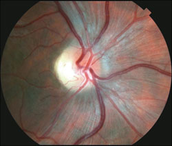 Figure 1c. Fundus photography showing temporal optic nerve pallor and maculopapillary retinal nerve fiber layer loss in the right eye.