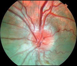 Figure 1d. Diffusely swollen optic nerve and peripapillary telangiectatic vessels in the left eye.