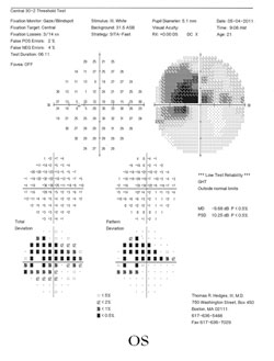 Figure 2a. Humphrey visual field 30-2 testing revealing a centrocecal scotoma in the left eye (2a).