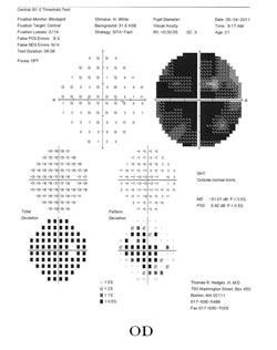 Figure 2b. Humphrey visual field 30-2 testing revealing patchy full-field defects in the right eye (2b).