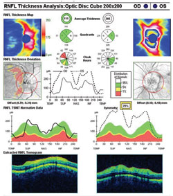 Figure 3.  OCT showing temporal nerve fiber layer thinning in the right eye and a thickened nerve fiber layer in the left eye.