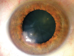 Case 1: Case of epithelial ingrowth and cataract. 