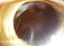 Case 2: After 32-cut RK, this patient underwent cataract surgery and ended up hyperopic.