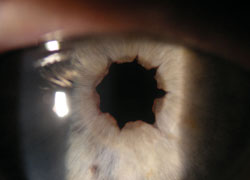 Case 3: A cosmetic pupil defect from multiple iris sphincterotomies performed during cataract surgery.