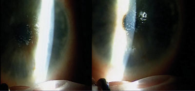 Figure 1. Slit lamp photographs showing significant corneal map-dot-fingerprint dystrophy affecting the visual axis. 