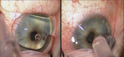 Figure 2.  Lidocaine jelly 2% is applied to the ocular surface.